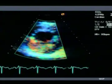 El electrocardiograma juvenil El electrocardiograma juvenil