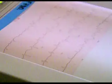 El reportaje, electrocardiograma infantil El reportaje, electrocardiograma infantil